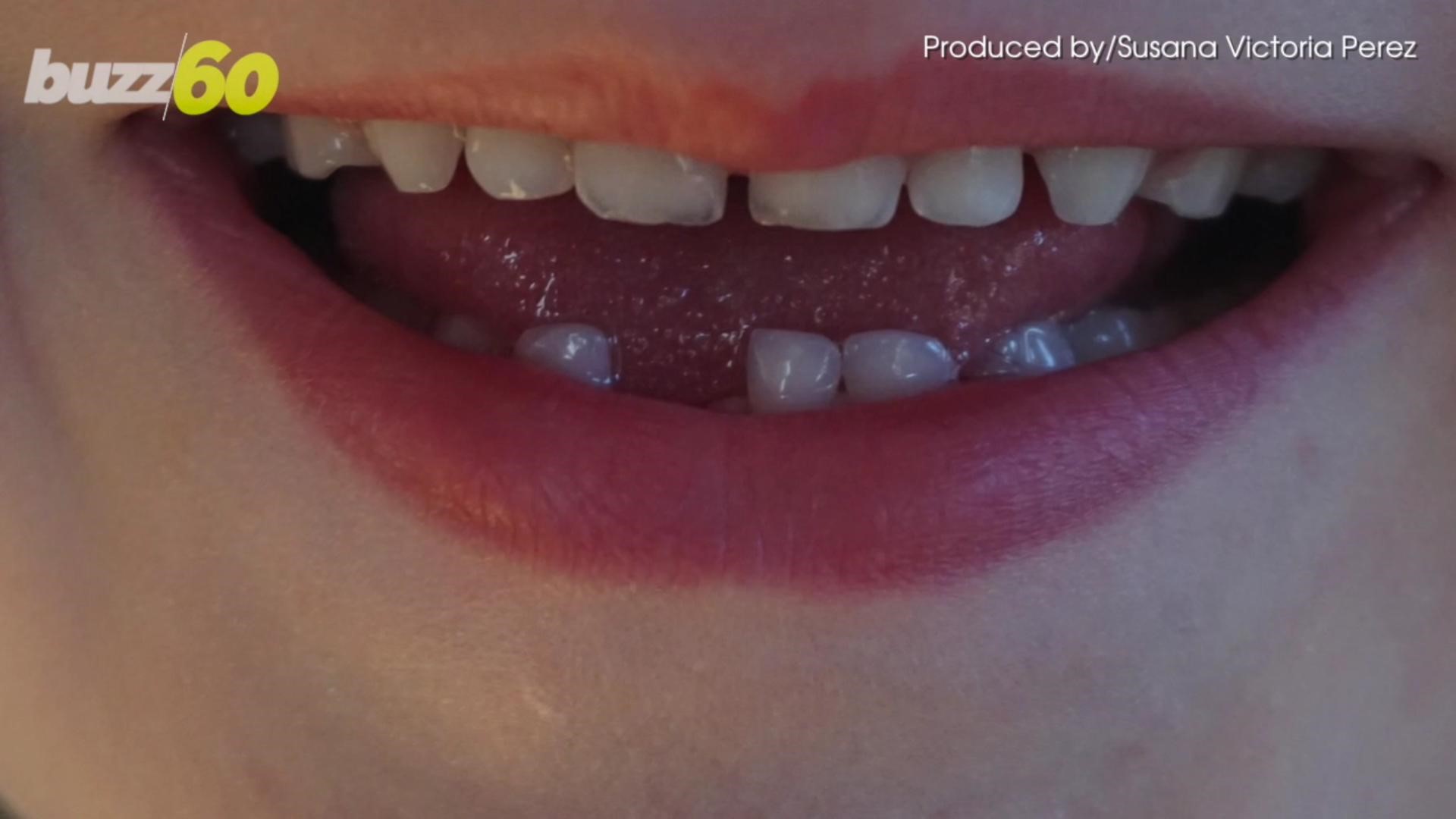 Тетрациклиновые зубы у детей