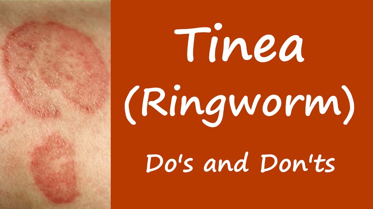 Ringworm Wallpapers